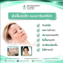 ฝังเข็มลดสิว