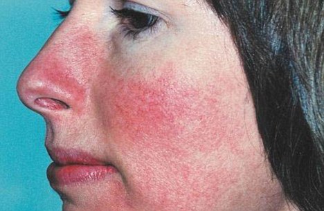 Rosacea
